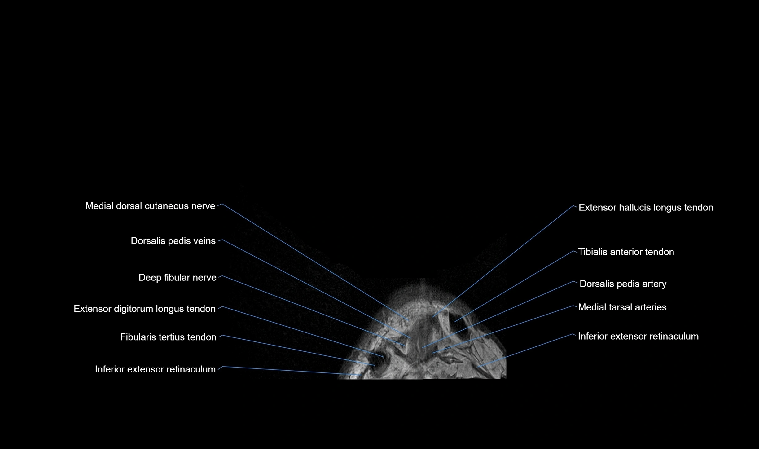MRI mid foot coronal ligaments cross sectional anatomy 3T  radiology  image-img-00001-00004.webp